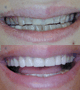 Empress Esthetics crowns