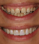 laser crrown lenghtening with veneers