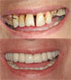 Smile Makeover
