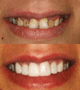 Veneers Emax HT