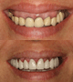extrem smile makeover gummy