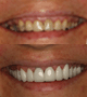 Full mouth E max Crowns