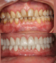 Full mouth Veneers