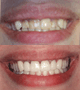 Emax veneers and crowns