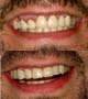 Zirconia